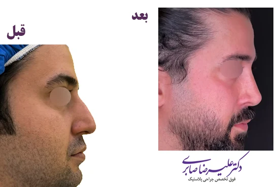 جراحی بینی مردانه