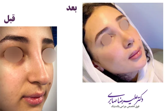 نمونه کار جراحی بینی استخوانی
