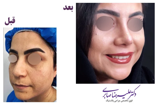 نمونه کار جراحی بینی دکتر صابری