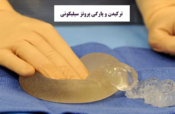 ترکیدن و پارگی پروتز سیلیکونی