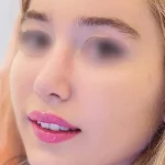 جراحی ترمیم بینی