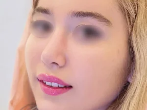 جراحی ترمیم بینی