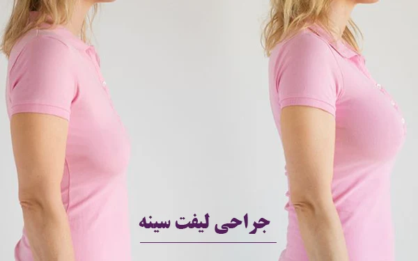 جراحی لیفت سینه
