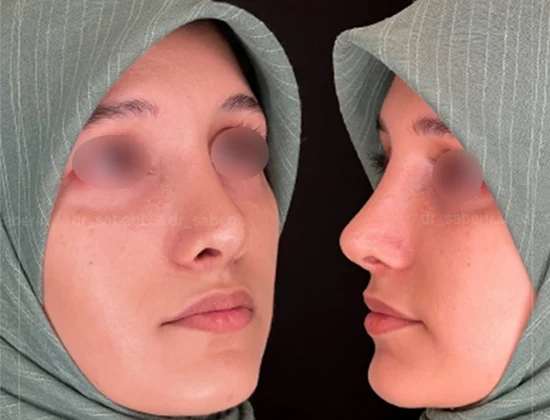نمونه کار عمل بینی دکتر صابری