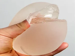 پارگی پروتز