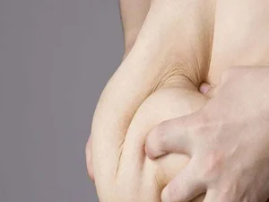 تفاوت لیپوماتیک و ابدومینوپلاستی