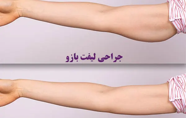 جراحی لیفت بازو