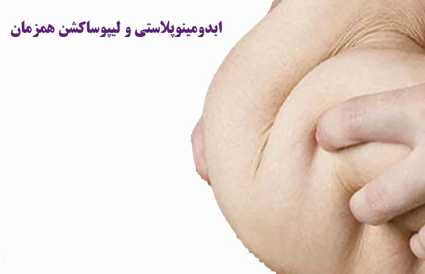 ابدومینوپلاستی و لیپوساکشن همزمان