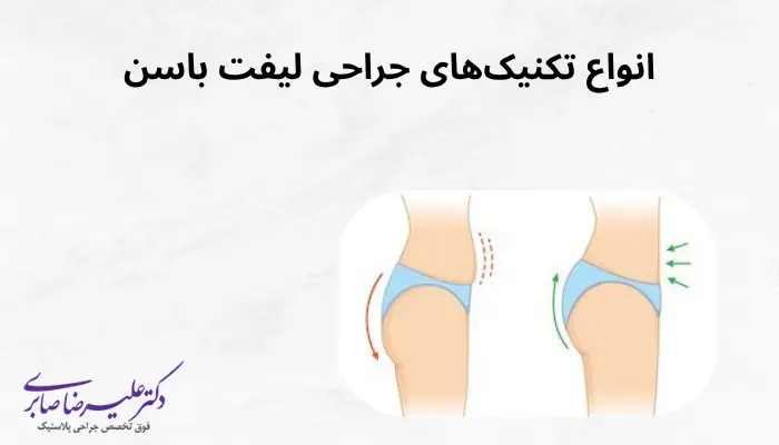 انواع تکنیکهای جراحی لیفت باسن