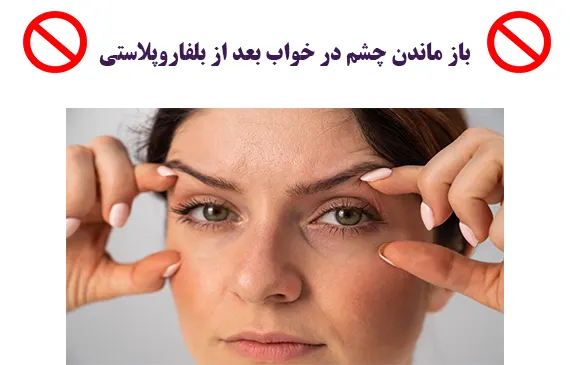 باز ماندن چشم در خواب بعد از بلفاروپلاستی