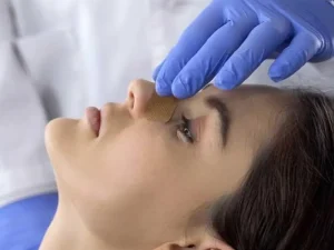 برداشتن گچ بینی