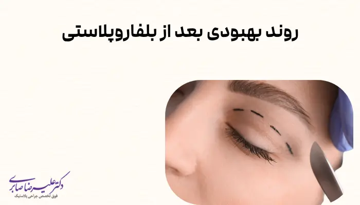روند بهبودی بعد از بلفاروپلاستی