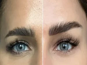 عمل لیفت شقیقه