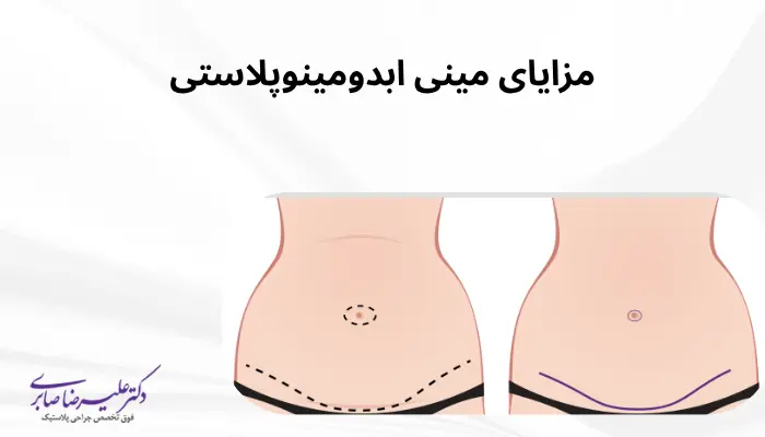 مزایای مینی ابدومینوپلاستی