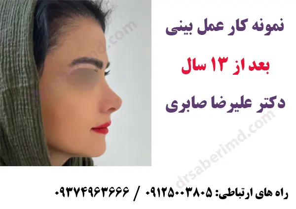 نمونه کار عمل بینی بهترین جراح بینی ایران