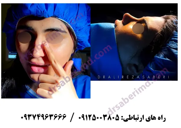 نمونه کار عمل بینی در تهران