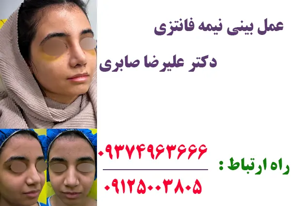 نمونه کار عمل بینی نیمه فانتزی در تهران