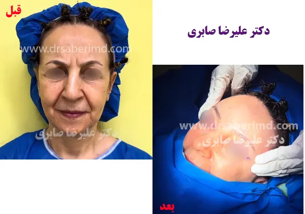 نمونه کار لیفت صورت دکتر علیرضا صابری