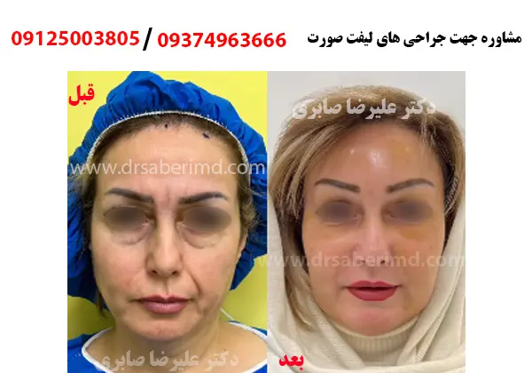 نمونه کار لیفت پیشانی دکتر علیرضا صابری