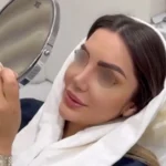 نمونه کار جراح پنجه طلای بینی ایران