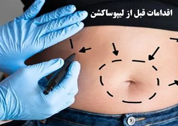 اقدامات قبل از لیپوساکشن