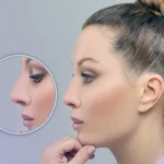 جراحی بینی با روش جدید