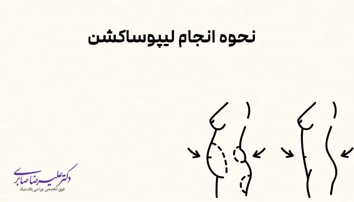 نحوه انجام لیپوساکشن