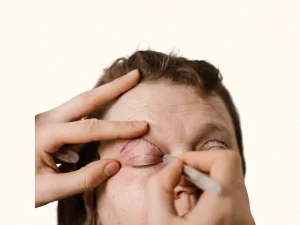 بهترین سن برای عمل بلفاروپلاستی