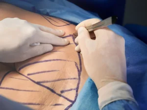 فرق لیپوماتیک با لیپوساکشن | کدام روش بهتر است؟