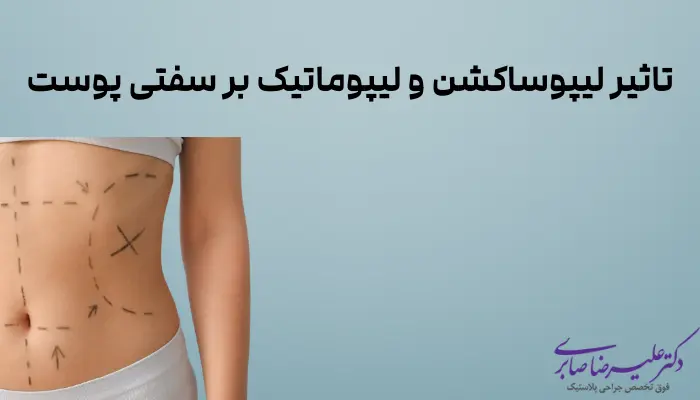 تاثیر لیپوساکشن و لیپوماتیک بر سفتی پوست