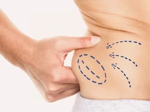 کبودی و تورم بعد از لیپوساکشن چقدر طول میکشد؟