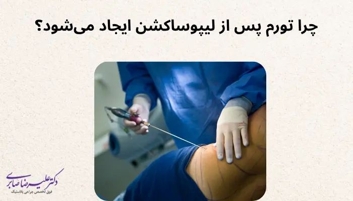 چرا تورم پس از لیپوساکشن ایجاد میشود؟ چرا تورم پس از لیپوساکشن ایجاد میشود؟