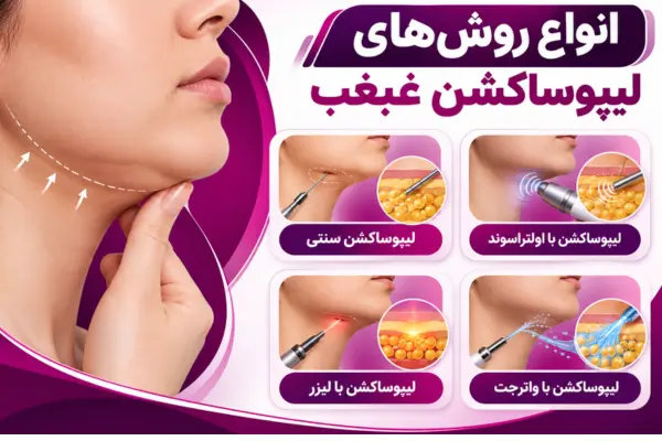 انواع روشهای لیپوساکشن غبغب