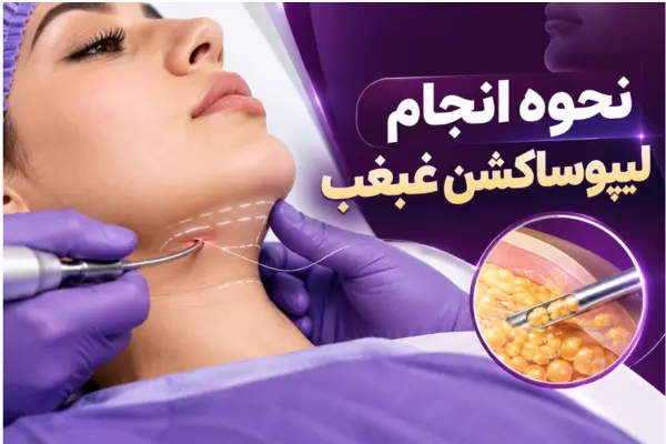 نحوه انجام لیپوساکشن غبغب